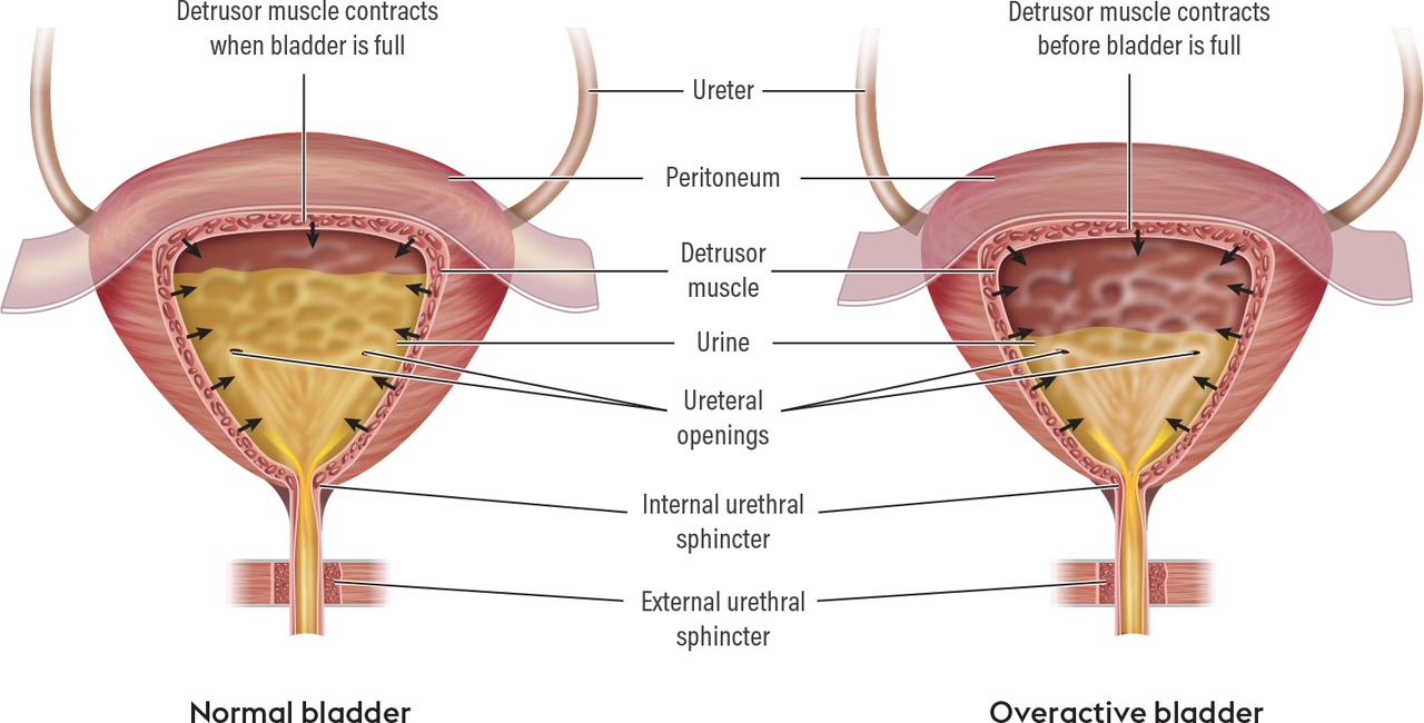 The Role of Mirabegron in Managing Urinary Incontinence