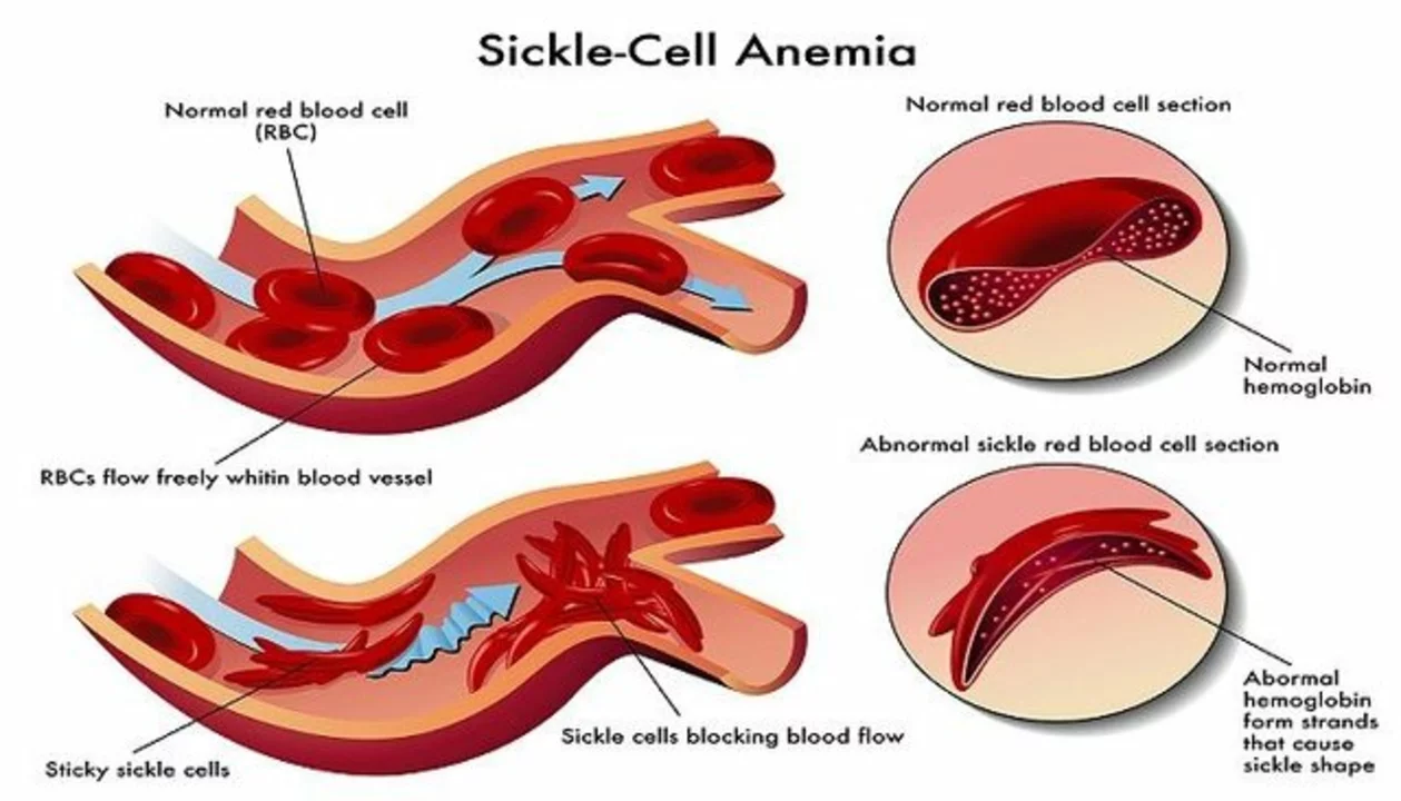 Pneumonia and Sickle Cell Disease: Risks and Prevention Strategies