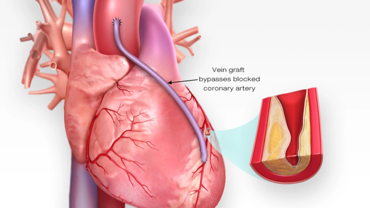 Coronary Artery Bypass Surgery: What to Expect and Recovery Tips